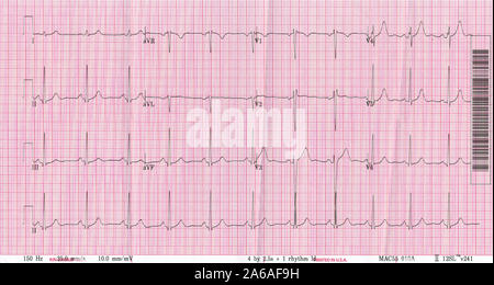 A copy of an ECG (Electrocardiogram) readout from a 60 year-old British male experiencing Hypertension (high blood pressure), on 22nd October 2019, in London, England. Electrocardiography is the process of producing an electrocardiogram, a recording – a graph of voltage versus time – of the electrical activity of the heart using electrodes placed on the skin. Stock Photo