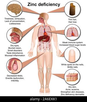 zinc deficiency 3d medical vector illustration isolated on white background infographic Stock Vector