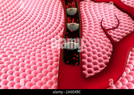 artery shown with a cut out section, Contraction of blood vessels, a blood clot in the vessels, High quality 3d render of blood cells, cholesterol in Stock Photo