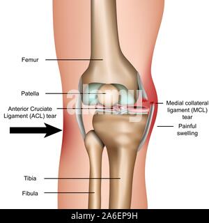 Dislocated knee, medial collateral ligament tear medical vector illustration isolated on white background Stock Vector