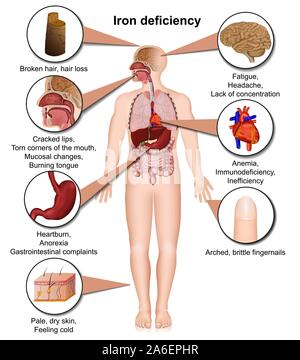 Iron deficiency effects on the body 3d medical vector illustration isolated on white background eps 10 infographic Stock Vector