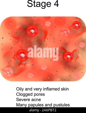 Stage 3 of development of acne. Inflamed skin with scars, acne and ...