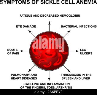 Symptoms of sickle cell anemia. World Sickle Cell Anemia Day 19 June. Red blood cells. Erythrocytes Sickle. Infographics. Vector illustration on Stock Vector