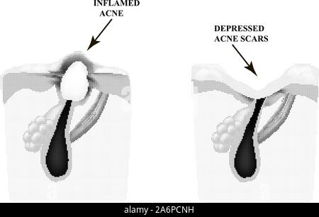 Inflamed acne on the skin. Inflamed pimple. The structure of the skin. Acne scar. Stock Vector