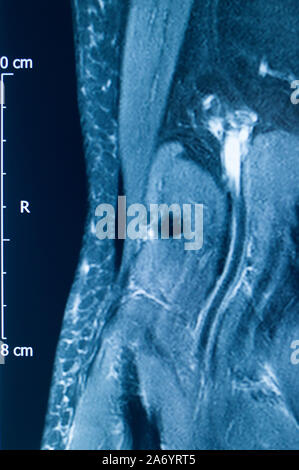 Knee sports injury mri mcl grade 2 tear magnetic resonance imaging ...