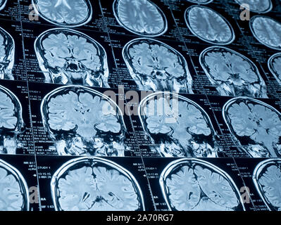 Magnetic resonance image (MRI) of the brain Stock Photo