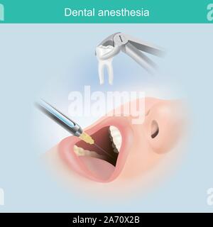 Dental anaesthesia. A jet injection aims a liquid medication dose for dental anaesthesia effect. Stock Vector