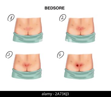 Illustration stages of decubitus ulcers Stock Photo