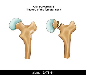 Illustration of the Fracture of the femoral neck. Osteosynthesis Stock Photo