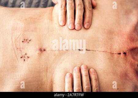 Scar from open heart surgery on the female body, where the sternum was cut in two, and the rib cage sprung. Image taken 30 days (1 month) following su Stock Photo