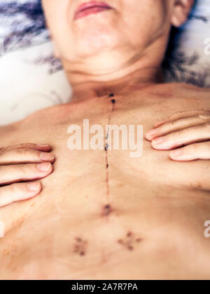 Scar from open heart surgery on the female body, where the sternum was cut in two, and the rib cage sprung. Image taken 30 days (1 month) following su Stock Photo