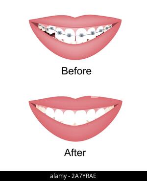 Crooked woman teeth before and after the orthodontic treatment with braces. Vector illustration isolated set Stock Vector