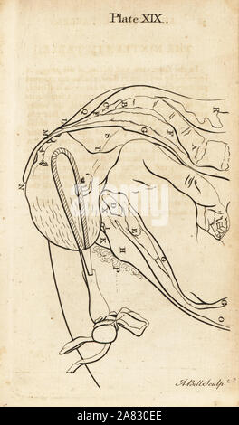 Foetus head brought lower down in the birth canal with forceps. Copperplate engraving by Andrew Bell after an illustration by Jan van Rymsdyk from William Smellie's A Set of Anatomical Tables, Charles Elliot, Edinburgh, 1780. Stock Photo