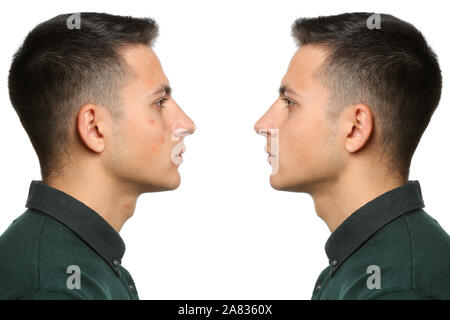 Acne problem. Young man before and after treatment on white background ...