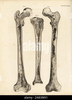 Longitudinal sections of the femur 1,2 and of the tibia 3. Copperplate engraving by Edward Mitchell after an anatomical illustration by Jean-Joseph Sue from John Barclay's A Series of Engravings of the Human Skeleton, MacLachlan and Stewart, Edinburgh, 1824. Stock Photo
