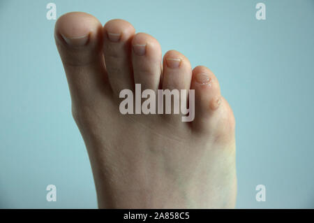 A corn plaster on the little toe of a foot, isolated on white background. Stock Photo