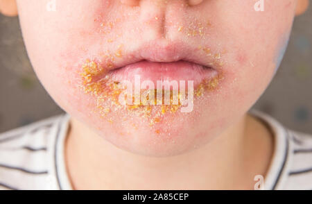 5 year old child with Impetigo (nonbullous impetigo) witch is is a bacterial infection that involves the superficial skin. Yellow scabs on infected ar Stock Photo