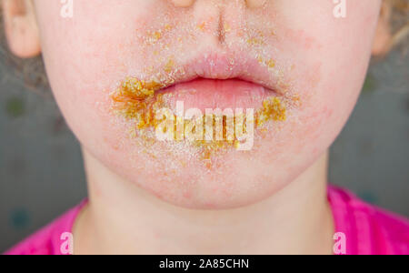 5 year old child with Impetigo (nonbullous impetigo) witch is is a bacterial infection that involves the superficial skin. Yellow scabs on infected ar Stock Photo