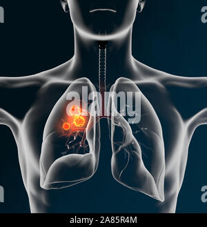 3D Illustration showing lung cancer Stock Photo - Alamy