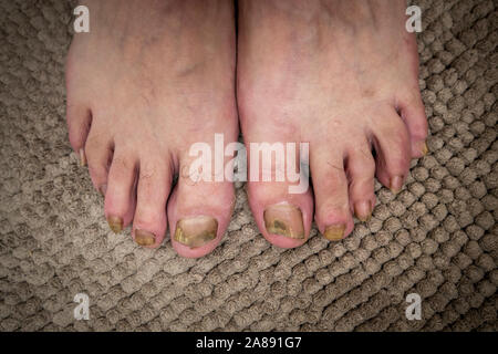 Onychomycosis with fungal nail infection two feet. Stock Photo