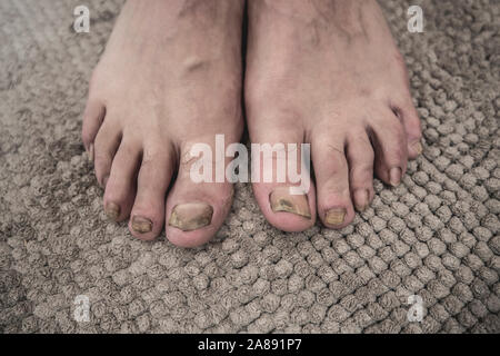 Onychomycosis with fungal nail infection two feet. Stock Photo