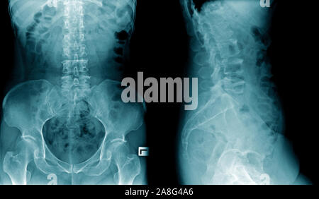 x-ray image human spine AP and lateral view in blue tone on black background Stock Photo