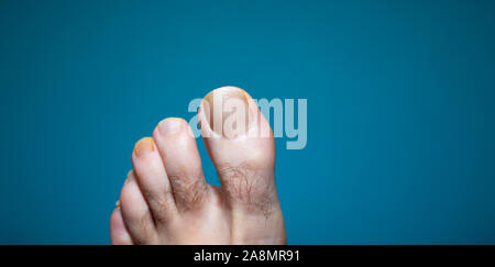 Extreme close up view of toenail infection on hairy man foot Stock Photo