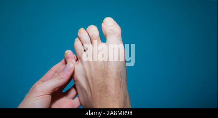 Close up on athlete foot toenail fungus infection Stock Photo