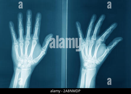 First Radiographers Hand an original radiography of human hand Stock Photo - Alamy