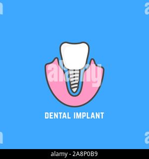 simple icon of white dental implant Stock Vector