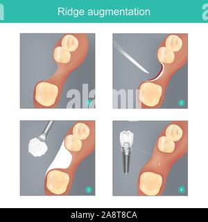 Ridge augmentation. The method dental used materials synthetic or human bone for Replace the Jawbone In missing, and to Prepare dental implant work to Stock Vector