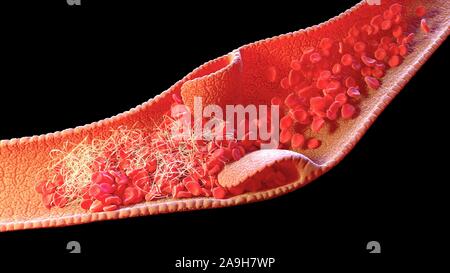 Blood clot inside a vein, illustration Stock Photo