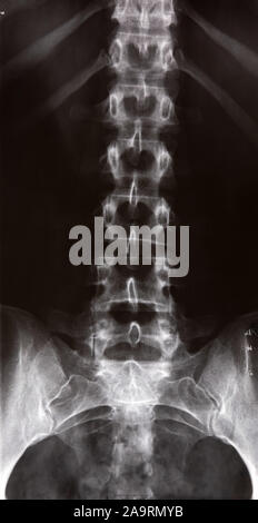X-ray of a human torso showing the Spine and Pelvis Stock Photo - Alamy