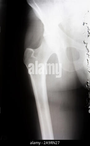 Hip xray. Human skeleton. Pelvis and femur bone. Anatomy Stock Photo ...