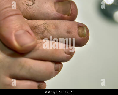 Close-up image of a fingernail on the right foot of a Caucasian man. The signs of mycosis of the small finger nail near the big toe are visible. Stock Photo