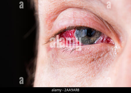 postoperative heavy inflamed eye closeup shot with selective focus and blur Stock Photo