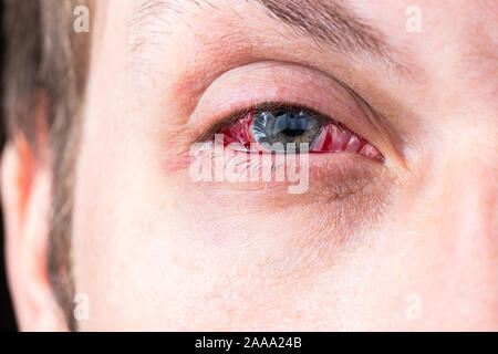 postoperative heavy inflamed eye closeup shot with selective focus and blur Stock Photo