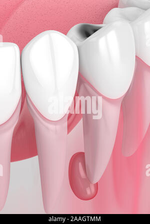 3d render of jaw with tooth cavity and cyst. Dental problem concept. Stock Photo