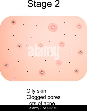 Stage 4 of development of acne. Inflamed skin with scars, acne and ...
