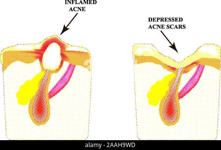 Inflamed acne on the skin. Inflamed pimple. The structure of the skin. Acne scar. Stock Vector