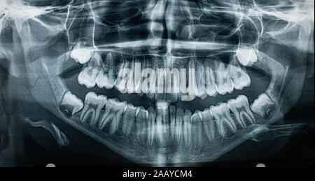 x-ray  jaw front view  ,concept medical , health care, Stock Photo