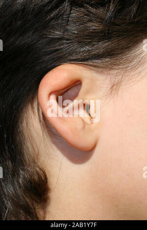 Deformed ear. Abnormal development of the auricle. Plastic surgery and cosmetology Stock Photo