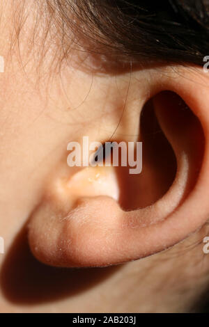 Deformed ear. Abnormal development of the auricle. Plastic surgery and cosmetology Stock Photo