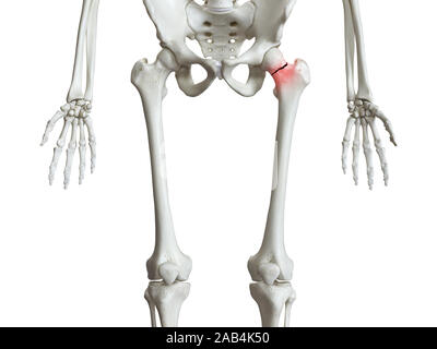 3d rendered medically accurate illustration of a broken femur neck Stock Photo