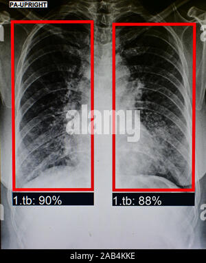flim x-ray patient's lung . has been AI diagnosed tuberculosis Stock Photo