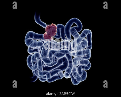 3d rendered medically accurate illustration of a small intestine tumor Stock Photo