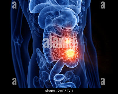 3d rendered medically accurate illustration of small intestine cancer Stock Photo