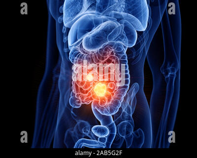 3d rendered medically accurate illustration of small intestine cancer Stock Photo