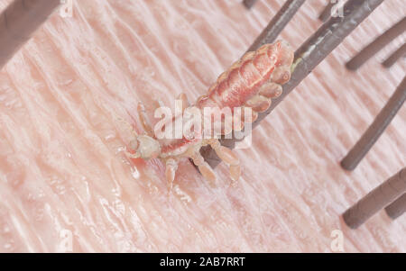 3d rendered illustration of a head louse on a human head Stock Photo