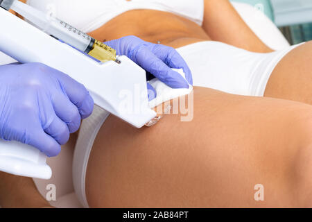 Therapist doing mesotherapy cellulite treatment with micro needle technology on female thigh. Stock Photo